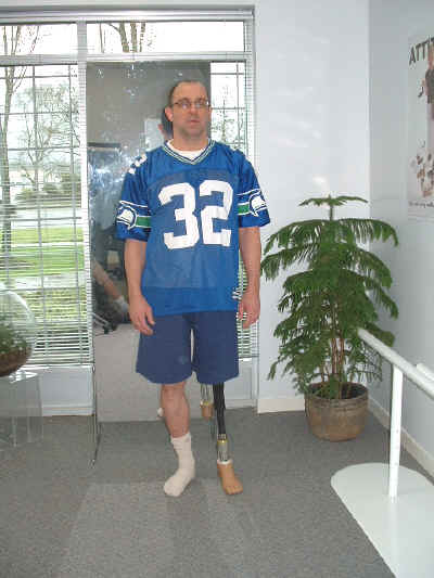 Larry Gardner-Amputee